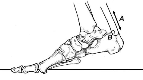 How to Beat an Insertional Achilles Injury