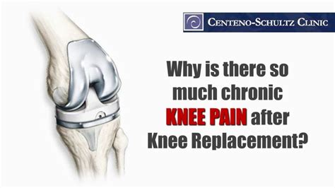 Knee Replacement & The Pain Afterwards - 5 Things to Know