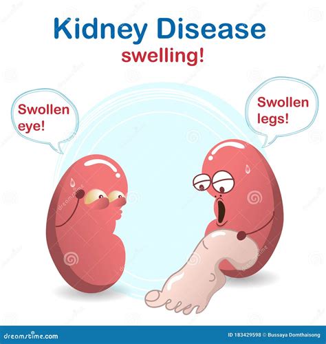 Sign and Symptom of Kidney Disease, Bad Health. Swollen of Leg and Eye, this Sign of a Kidney ...