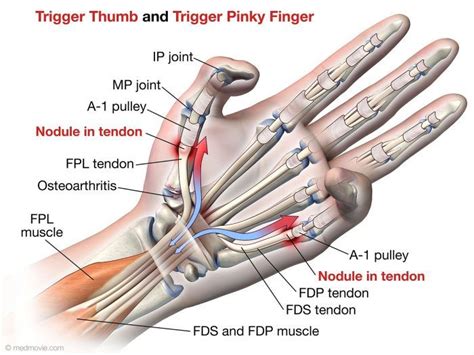 Trigger Finger Fort Worth, TX - The Hand to Shoulder Center