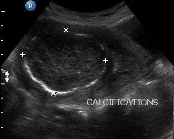 b a (transabdominal) and 5b (transvaginal) shows a pedunculated fibroid ...