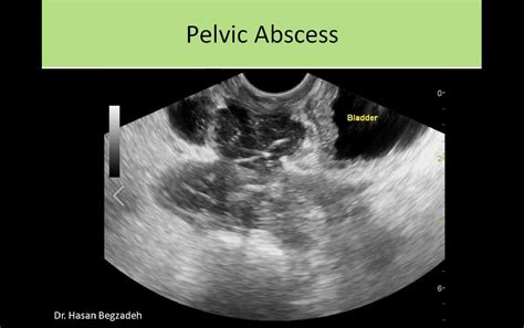 pelvic abscess