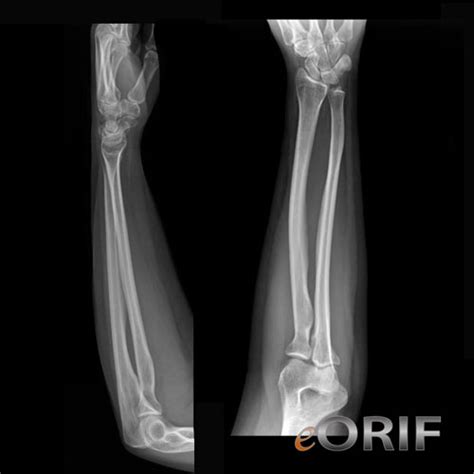 Forearm Xray | eORIF