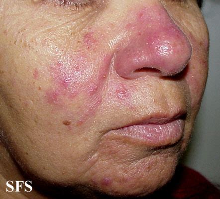 Rosacea - wikidoc