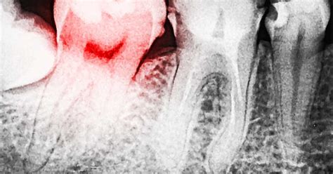 Treatment of Dental Caries | Radixdent