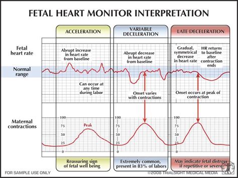 fetal heart monitor interpretation | Nursing school tips, Nursing mnemonics, Ob nursing