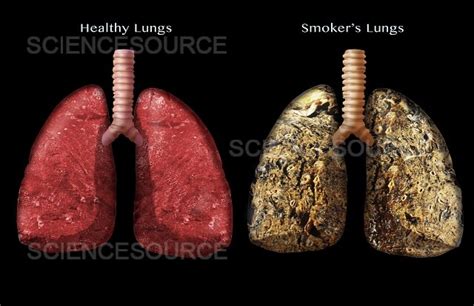 Pot Smokers Lungs Vs Healthy Lungs