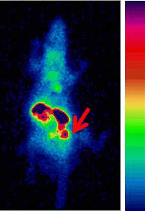 Nuclear medicine (SPECT) imaging using 99mTc-MIBI. Static image of an ...