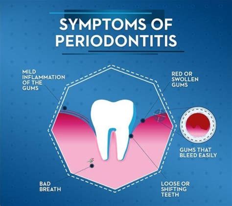 Calculus Bridge, Symptoms, Treatment | Healthfyy