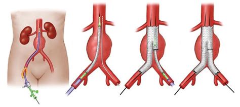 Endovascular repair of abdominal aortic aneurysms - Para Profesionales ...