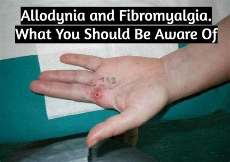 Allodynia and Fibromyalgia. What You Should Be Aware Of – Fibromyalgia ...