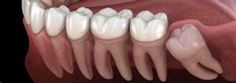 Wisdom Tooth Pain, What You Need To Know About Wisdom Teeth