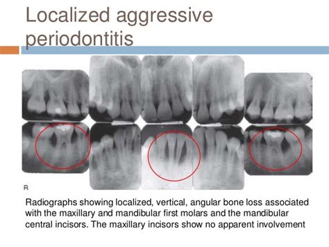 Aggressive periodontitis