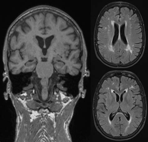 Magnetic resonance imaging (MRI) displaying bihemispheric ...