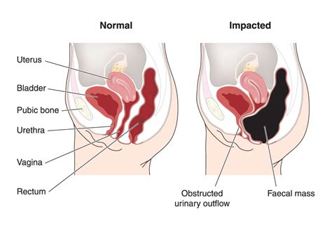 Constipation - Net Health Book