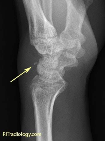 RiT radiology: Triquetral Fracture