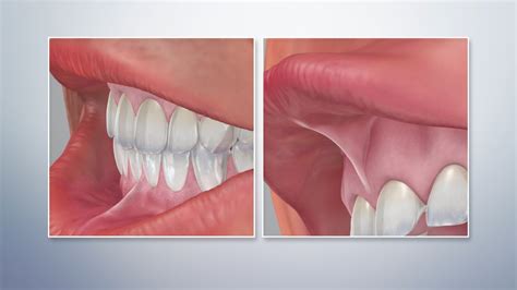 Lingual Frenectomy Procedure