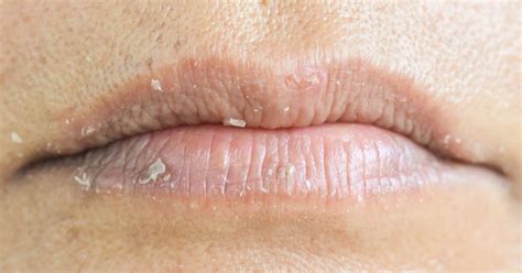 Eczema on the lips: Types, triggers, causes, and treatment