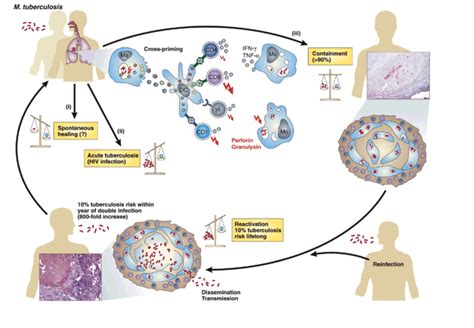 Adding Layers to my Understanding of Tuberculosis — Tracking Zebra