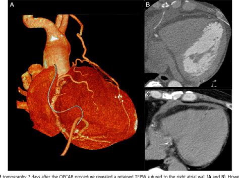 [PDF] Migration of a retained temporary epicardial pacing wire into an ...