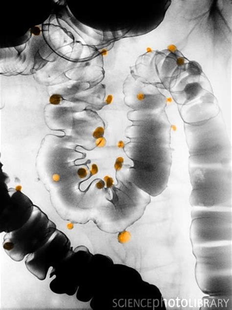 Diverticulosis, Barium Contrast X-ray. Diverticulitis is small, bulging sacs or pouches of the ...