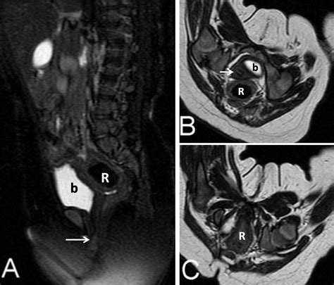 MRI of persistent cloaca: Can it substitute conventional imaging ...