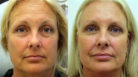 Botox Treatment Utah County | Utah Valley Dermatology