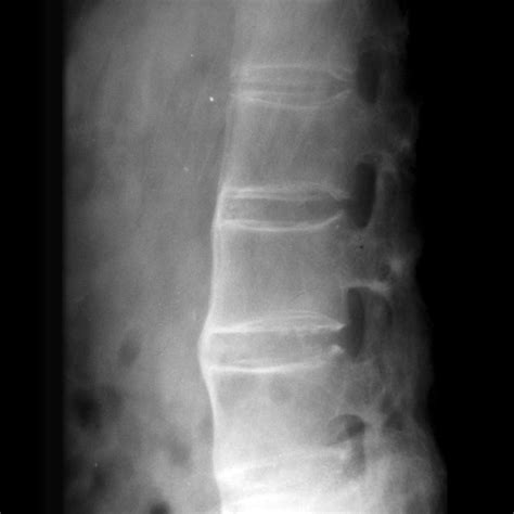 Genetics of Ankylosing Spondylitis Study (GASS) - Australian Translational Genomics Centre