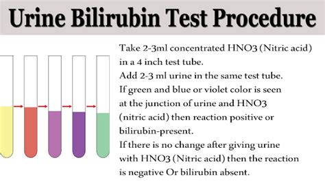 Urine Bilirubin test procedure: Nitric Acid Test.