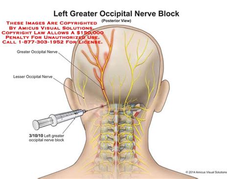 Left Greater Occipital Nerve Block