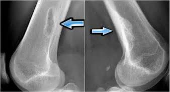 The Radiology Assistant : Bone - Sclerotic tumors and tumor-like lesions