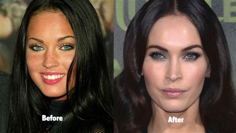 Megan Fox Plastic Surgery Before and After Photos