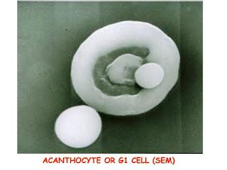 Renal Fellow Network: The Acanthocyte