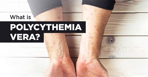 Polycythemia Vera Skin Conditions: Causes And Treatments, 46% OFF