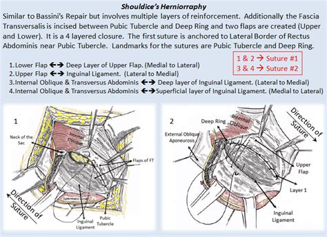 Diagram Of Inguinal Hernia Repair