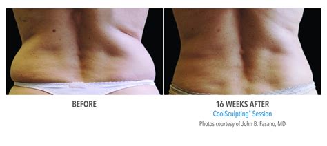 CoolSculpting Flank / Back Before and After Photos NYC