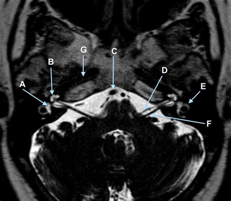 High resolution axial T2 weighted magnetic resonance imaging of the posterior fossa | The BMJ