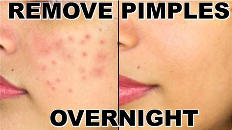 How To Remove Pimples Overnight | Acne Treatment | ShrutiArjunAnand - YouTube