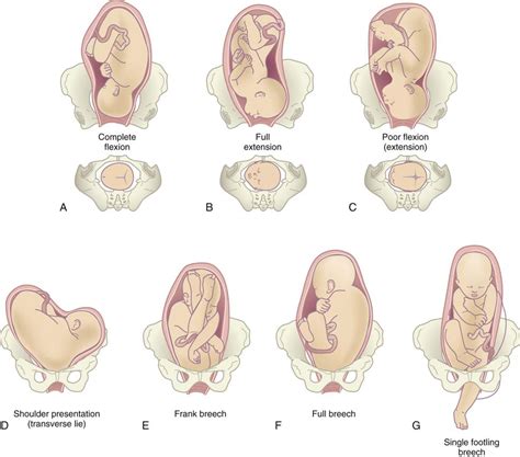 6. Nursing Care of Mother and Infant During Labor and Birth | Nurse Key