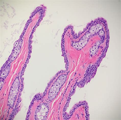 Steatocystoma Multiplex Histology