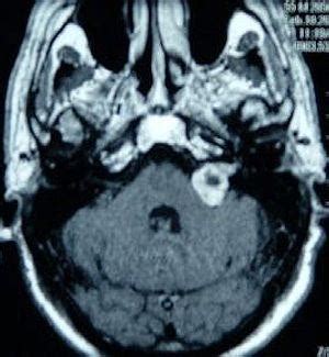 Recovery time for acoustic neuroma surgery | Nervous System Disorders ...