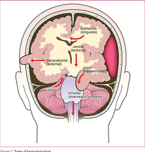 [PDF] Clinical Manifestations of Intracranial Hypertension and Herniation Syndrome | Semantic ...