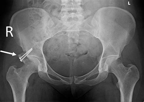 Anteroposterior pelvis postoperative x-ray showing final result on the ...