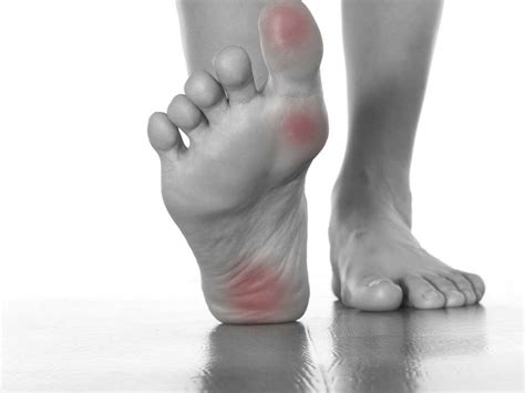 Plantar Fasciitis: 10 Plantar Fasciitis Symptoms