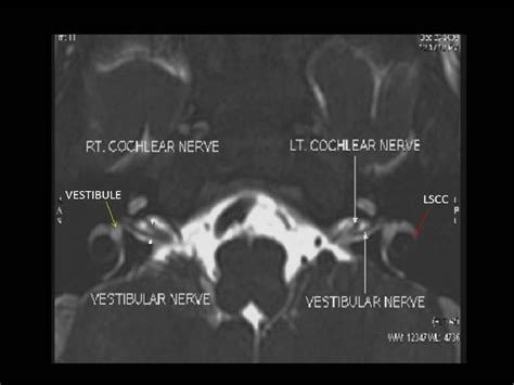 Figure 6 from High-field MRI versus high-resolution CT of temporal bone in inner ear pathologies ...