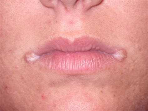 Angular Cheilitis (Perleche, Angular Stomatitis, Cheilosis)