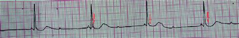 Electrocardiogram showing Osborn waves. | Download Scientific Diagram