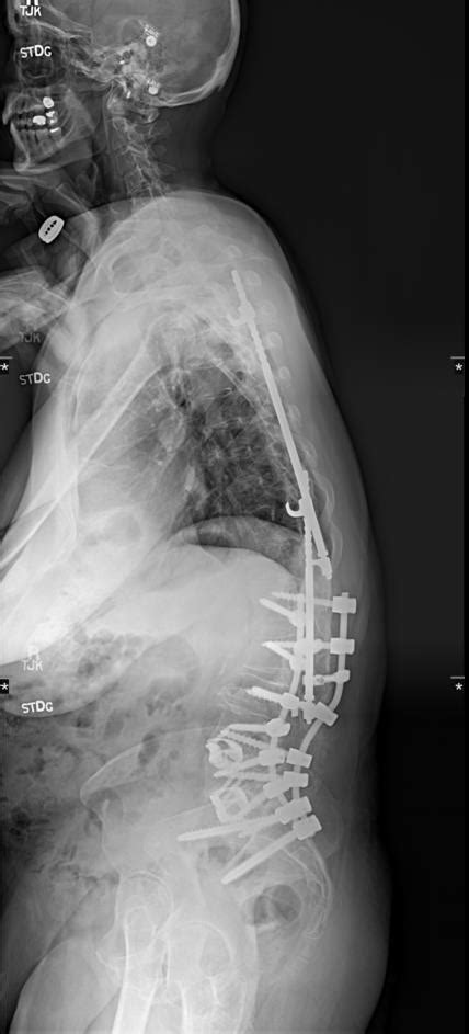 Harrington Rod Extension to the Pelvis and Multilevel Anterior Lumbar ...