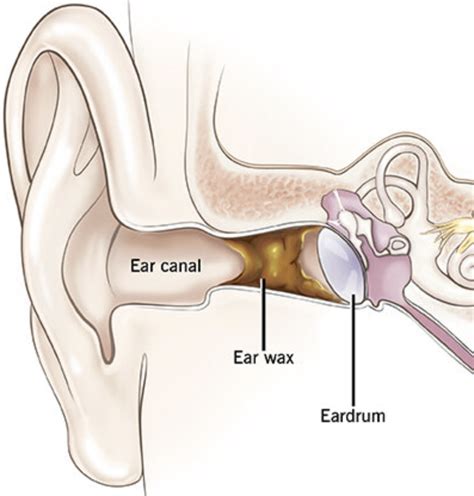 Impacted Ear Wax - MODO Urgent Care & Medical Concierge Wellness Center