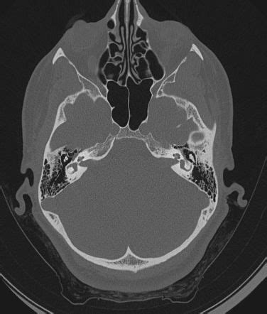 Petrous part of temporal bone | Radiology Reference Article ...